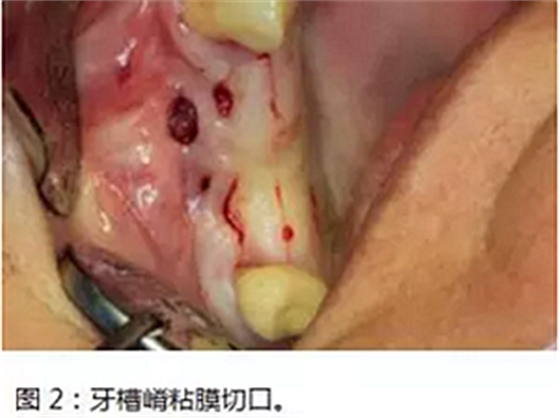 上颌窦瘘修补术——改良式旋转带蒂粘膜瓣修补术的应用