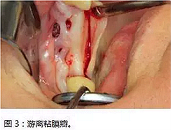 上颌窦瘘修补术——改良式旋转带蒂粘膜瓣修补术的应用