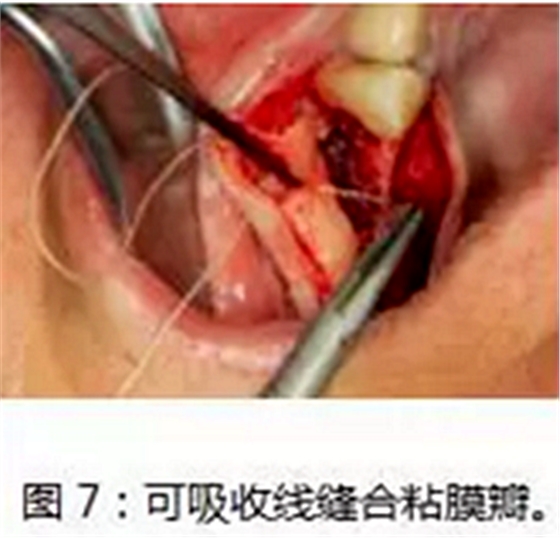 上颌窦瘘修补术——改良式旋转带蒂粘膜瓣修补术的应用