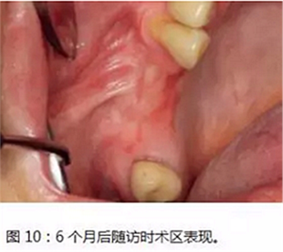 上颌窦瘘修补术——改良式旋转带蒂粘膜瓣修补术的应用