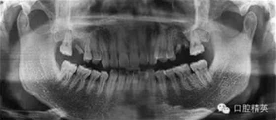 种植手术临床与曲面断层综合判断失败病例的思与考