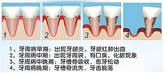牙周病发展过程