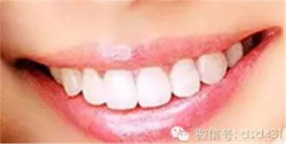 是什么导致了义齿返工？？？