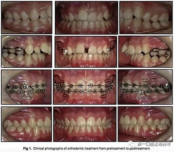 正畸文献阅读--正畸过程中牙根移动的三维监测