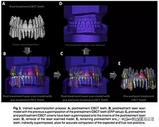 正畸文献阅读--正畸过程中牙根移动的三维监测
