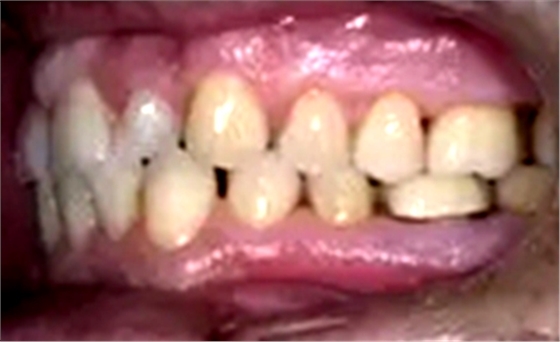 个案报导--牙列取模后下颌骨舌侧坏死