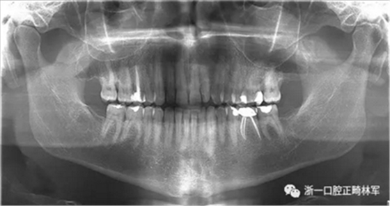 个案报导--牙列取模后下颌骨舌侧坏死