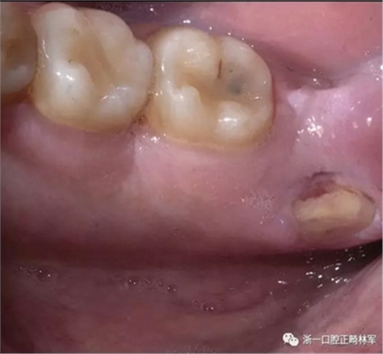个案报导--牙列取模后下颌骨舌侧坏死