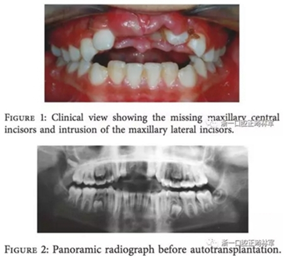 文献优秀正畸病例赏析--上颌中切牙区受伤后自体牙移植及正畸治疗13年随访病例