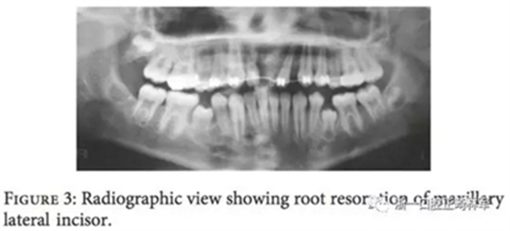 文献优秀正畸病例赏析--上颌中切牙区受伤后自体牙移植及正畸治疗13年随访病例