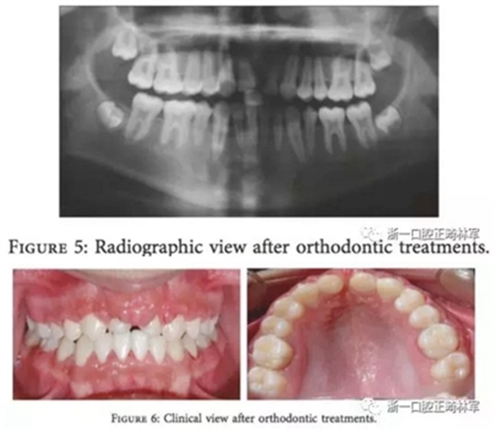 文献优秀正畸病例赏析--上颌中切牙区受伤后自体牙移植及正畸治疗13年随访病例