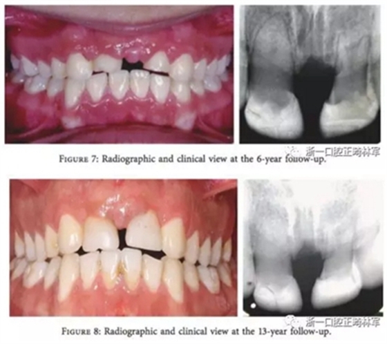 文献优秀正畸病例赏析--上颌中切牙区受伤后自体牙移植及正畸治疗13年随访病例
