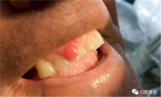 激光在根管治疗中的魅力是怎样体现的? 激光在根管治疗中的魅力是怎样体现的?