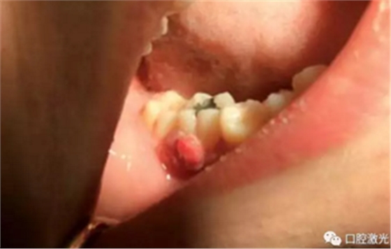 激光在根管治疗中的魅力是怎样体现的? 激光在根管治疗中的魅力是怎样体现的?