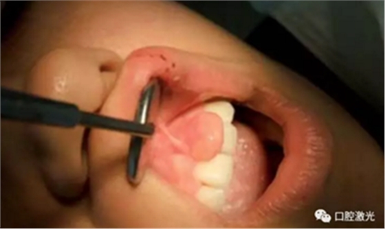 激光在根管治疗中的魅力是怎样体现的? 激光在根管治疗中的魅力是怎样体现的?