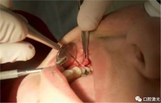 激光在根管治疗中的魅力是怎样体现的? 激光在根管治疗中的魅力是怎样体现的?