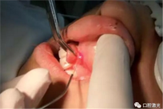 激光在根管治疗中的魅力是怎样体现的? 激光在根管治疗中的魅力是怎样体现的?