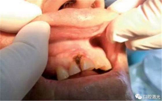 激光在根管治疗中的魅力是怎样体现的? 激光在根管治疗中的魅力是怎样体现的?