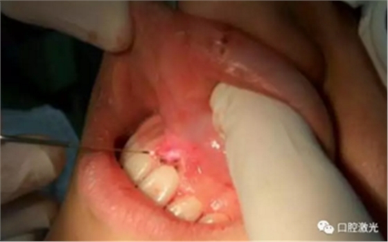 激光在根管治疗中的魅力是怎样体现的? 激光在根管治疗中的魅力是怎样体现的?