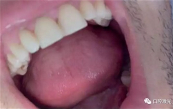 激光在根管治疗中的魅力是怎样体现的? 激光在根管治疗中的魅力是怎样体现的?