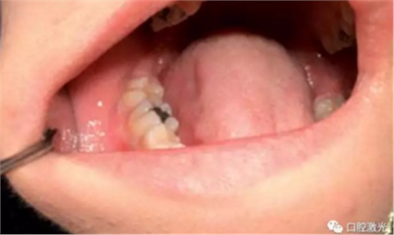 激光在根管治疗中的魅力是怎样体现的? 激光在根管治疗中的魅力是怎样体现的?