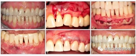2016口腔医师资格考试-口组-牙周膜 2016口腔医师资格考试-口组-牙周膜