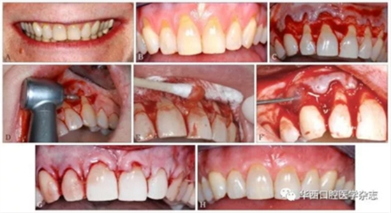2016口腔医师资格考试-口组-牙周膜 2016口腔医师资格考试-口组-牙周膜