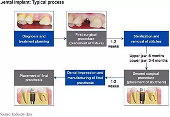 种植体，在全球牙科设备市场的变化！