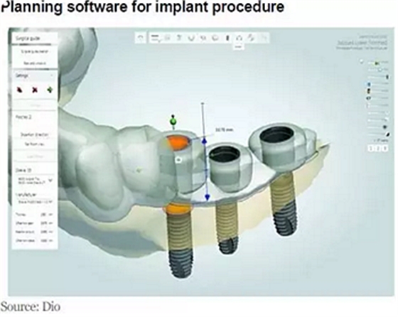 种植体，在全球牙科设备市场的变化！