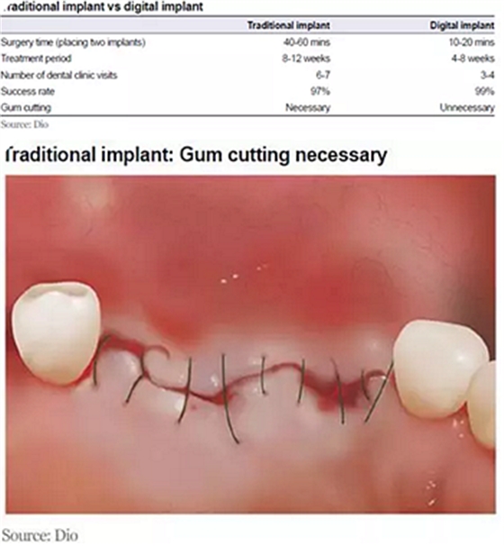 种植体，在全球牙科设备市场的变化！