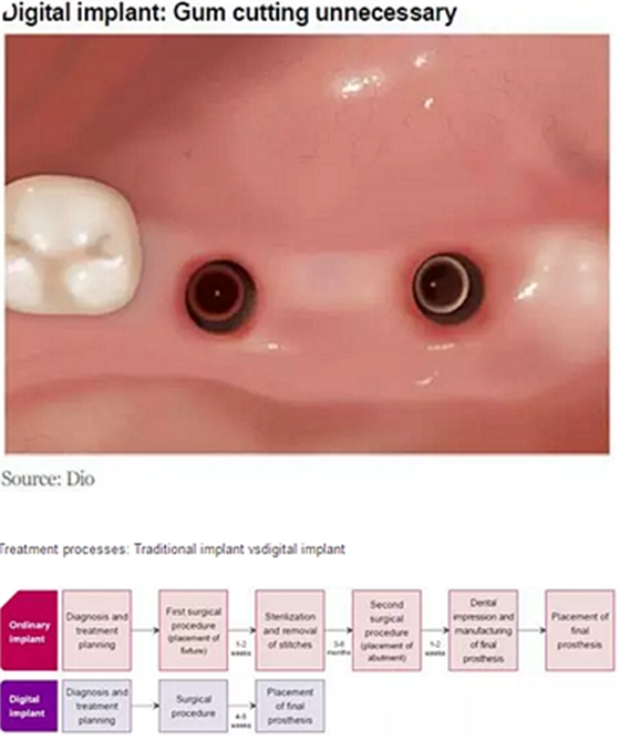 种植体，在全球牙科设备市场的变化！