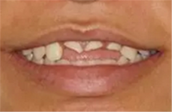 【病例分享】上颌多颗相邻前牙的“精确化”即刻种植修复一例 【病例分享】上颌多颗相邻前牙的“精确化”即刻种植修复一例