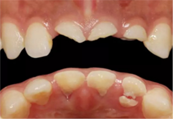 【病例分享】上颌多颗相邻前牙的“精确化”即刻种植修复一例 【病例分享】上颌多颗相邻前牙的“精确化”即刻种植修复一例