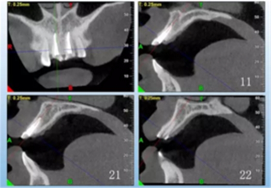 【病例分享】上颌多颗相邻前牙的“精确化”即刻种植修复一例 【病例分享】上颌多颗相邻前牙的“精确化”即刻种植修复一例
