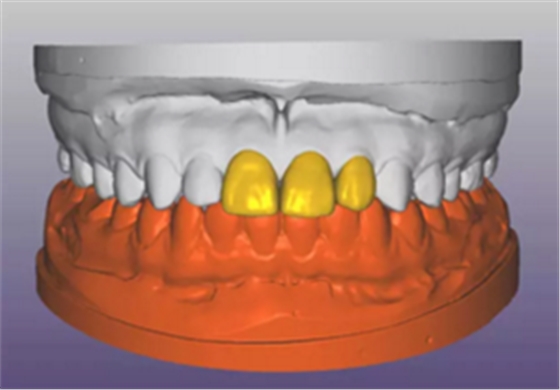 【病例分享】上颌多颗相邻前牙的“精确化”即刻种植修复一例 【病例分享】上颌多颗相邻前牙的“精确化”即刻种植修复一例
