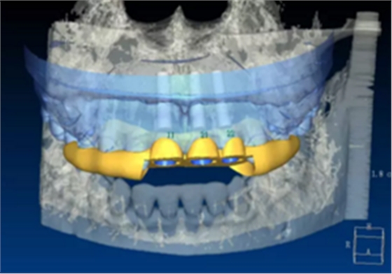 【病例分享】上颌多颗相邻前牙的“精确化”即刻种植修复一例 【病例分享】上颌多颗相邻前牙的“精确化”即刻种植修复一例