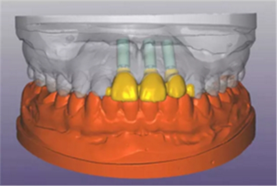 【病例分享】上颌多颗相邻前牙的“精确化”即刻种植修复一例 【病例分享】上颌多颗相邻前牙的“精确化”即刻种植修复一例