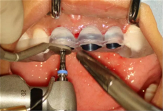【病例分享】上颌多颗相邻前牙的“精确化”即刻种植修复一例 【病例分享】上颌多颗相邻前牙的“精确化”即刻种植修复一例