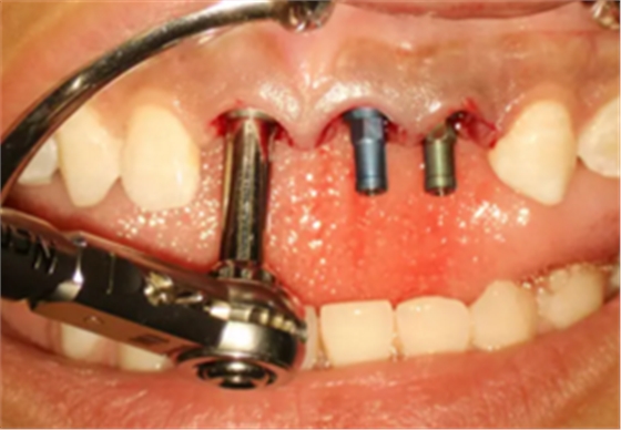 【病例分享】上颌多颗相邻前牙的“精确化”即刻种植修复一例 【病例分享】上颌多颗相邻前牙的“精确化”即刻种植修复一例