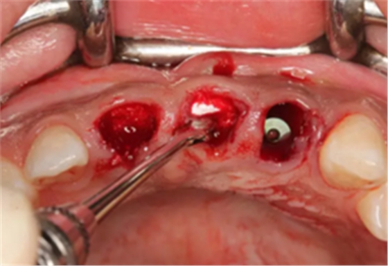 【病例分享】上颌多颗相邻前牙的“精确化”即刻种植修复一例 【病例分享】上颌多颗相邻前牙的“精确化”即刻种植修复一例