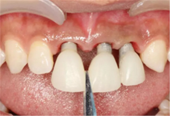 【病例分享】上颌多颗相邻前牙的“精确化”即刻种植修复一例 【病例分享】上颌多颗相邻前牙的“精确化”即刻种植修复一例