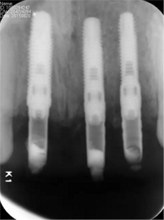 【病例分享】上颌多颗相邻前牙的“精确化”即刻种植修复一例 【病例分享】上颌多颗相邻前牙的“精确化”即刻种植修复一例