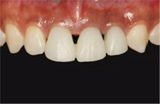 【病例分享】上颌多颗相邻前牙的“精确化”即刻种植修复一例 【病例分享】上颌多颗相邻前牙的“精确化”即刻种植修复一例