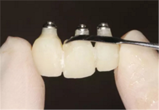 【病例分享】上颌多颗相邻前牙的“精确化”即刻种植修复一例 【病例分享】上颌多颗相邻前牙的“精确化”即刻种植修复一例