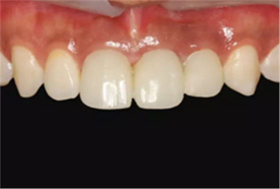 【病例分享】上颌多颗相邻前牙的“精确化”即刻种植修复一例 【病例分享】上颌多颗相邻前牙的“精确化”即刻种植修复一例