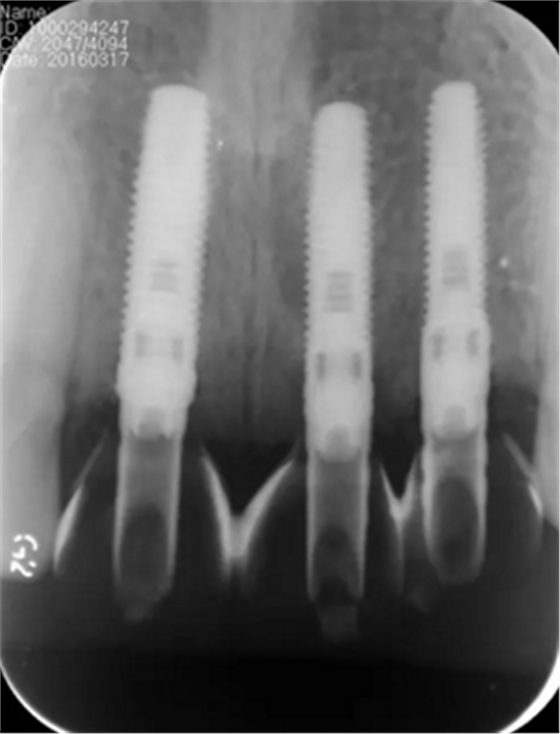 【病例分享】上颌多颗相邻前牙的“精确化”即刻种植修复一例 【病例分享】上颌多颗相邻前牙的“精确化”即刻种植修复一例
