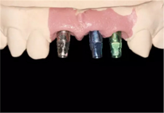 【病例分享】上颌多颗相邻前牙的“精确化”即刻种植修复一例 【病例分享】上颌多颗相邻前牙的“精确化”即刻种植修复一例