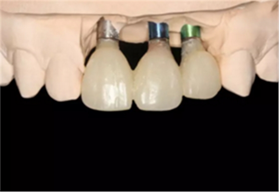 【病例分享】上颌多颗相邻前牙的“精确化”即刻种植修复一例 【病例分享】上颌多颗相邻前牙的“精确化”即刻种植修复一例
