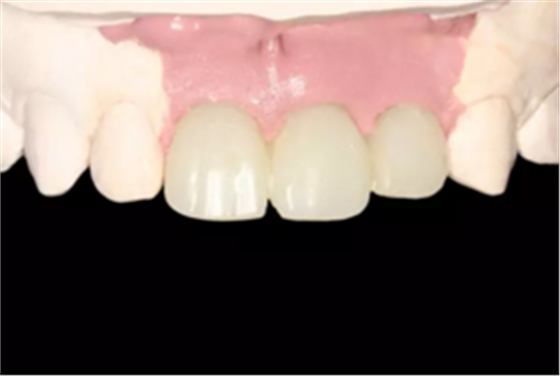 【病例分享】上颌多颗相邻前牙的“精确化”即刻种植修复一例 【病例分享】上颌多颗相邻前牙的“精确化”即刻种植修复一例