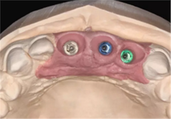 【病例分享】上颌多颗相邻前牙的“精确化”即刻种植修复一例 【病例分享】上颌多颗相邻前牙的“精确化”即刻种植修复一例